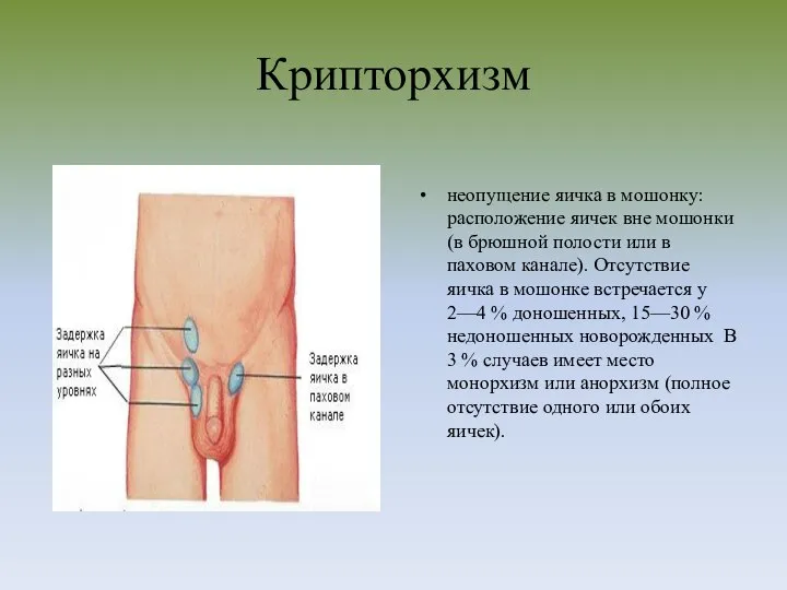 Крипторхизм неопущение яичка в мошонку: расположение яичек вне мошонки (в брюшной