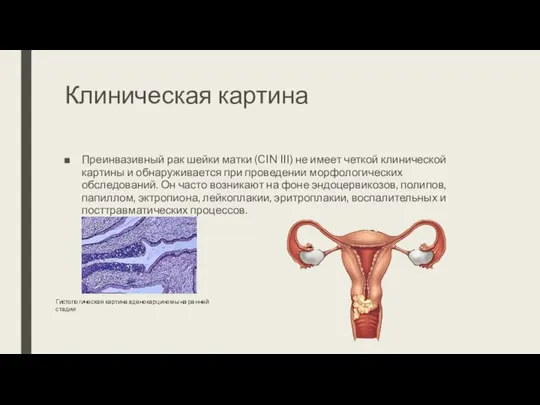 Клиническая картина Преинвазивный рак шейки матки (CIN III) не имеет четкой