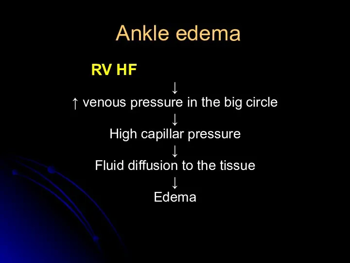 Ankle edema RV HF ↓ ↑ venous pressure in the big