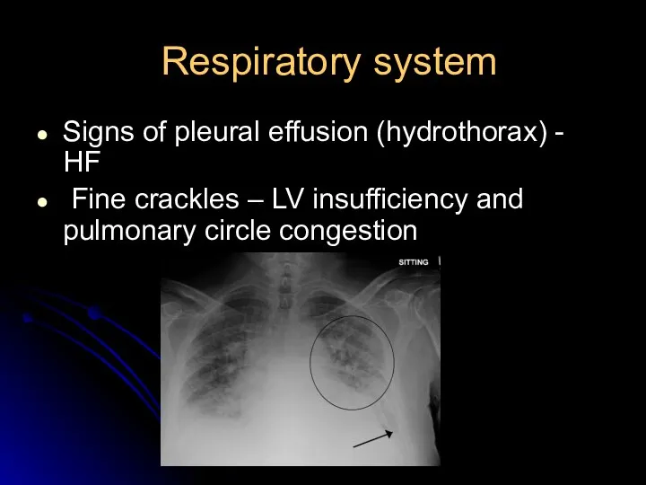 Respiratory system Signs of pleural effusion (hydrothorax) - HF Fine crackles