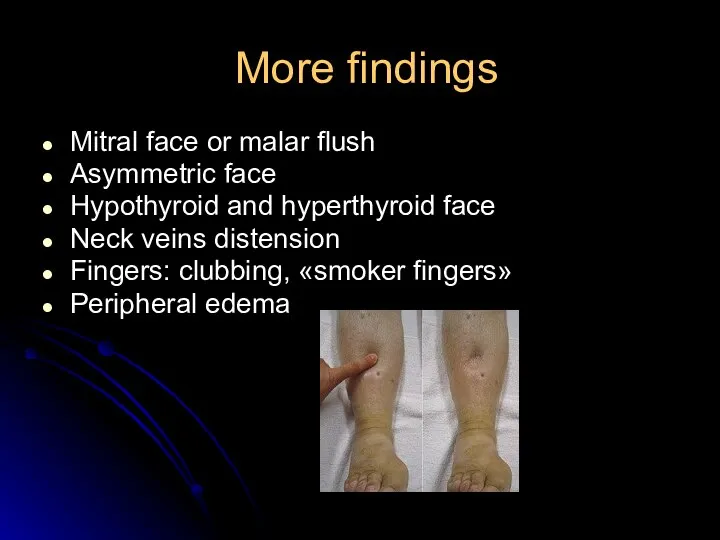 More findings Mitral face or malar flush Asymmetric face Hypothyroid and