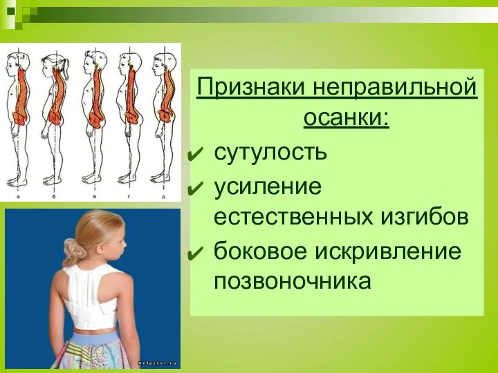 Признаки неправильной осанки: сутулость усиление естественных изгибов боковое искривление позвоночника