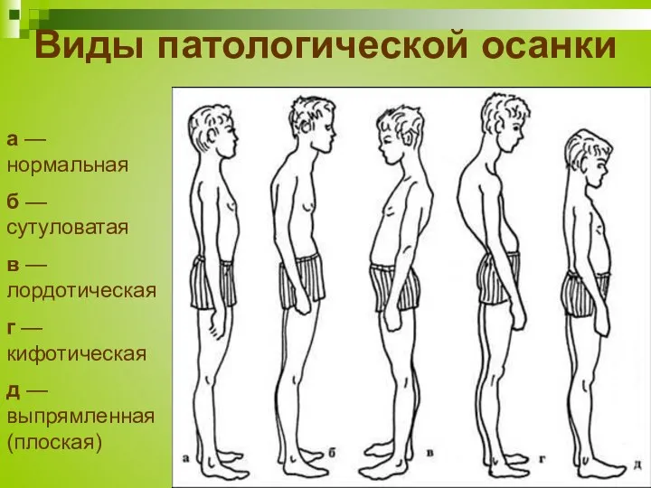 Виды патологической осанки а — нормальная б — сутуловатая в —