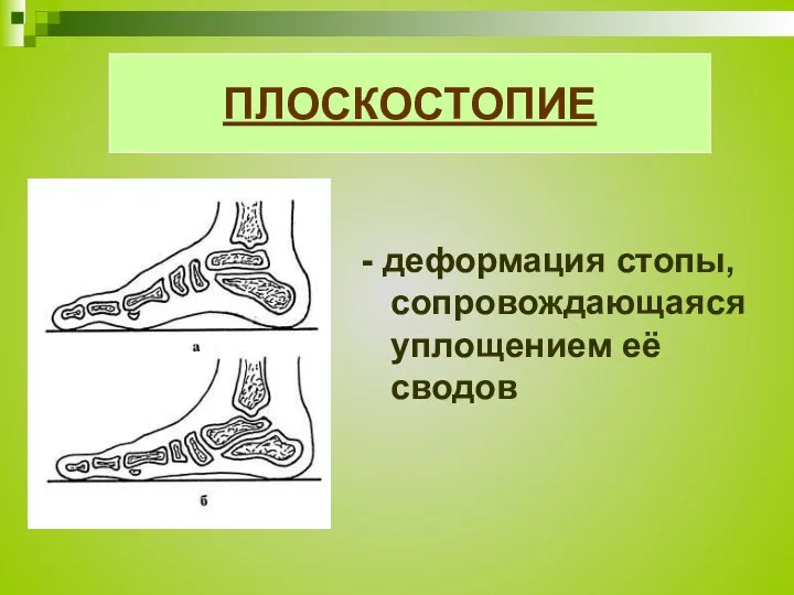 ПЛОСКОСТОПИЕ - деформация стопы, сопровождающаяся уплощением её сводов