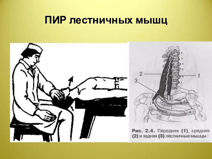 ПИР лестничных мышц