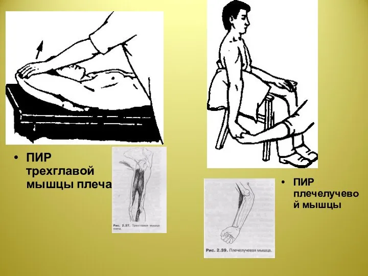 ПИР трехглавой мышцы плеча ПИР плечелучевой мышцы