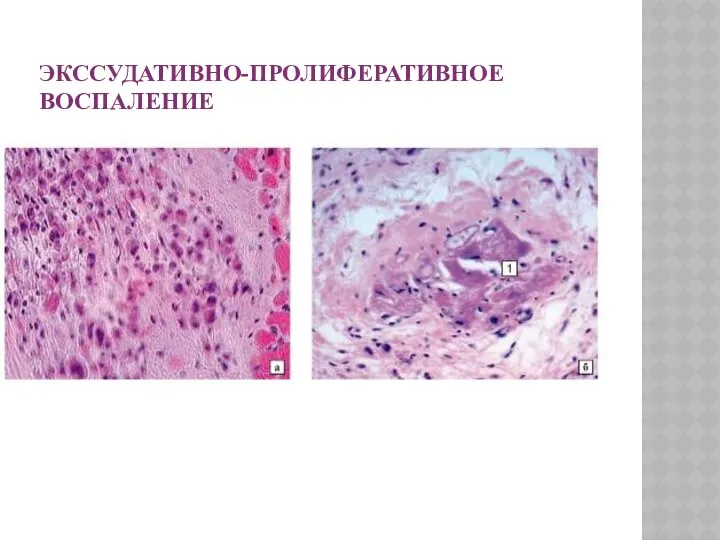 ЭКССУДАТИВНО-ПРОЛИФЕРАТИВНОЕ ВОСПАЛЕНИЕ