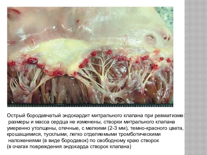 Острый бородавчатый эндокардит митрального клапана при ревматизме: размеры и масса сердца
