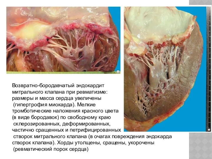 Возвратно-бородавчатый эндокардит митрального клапана при ревматизме: размеры и масса сердца увеличены