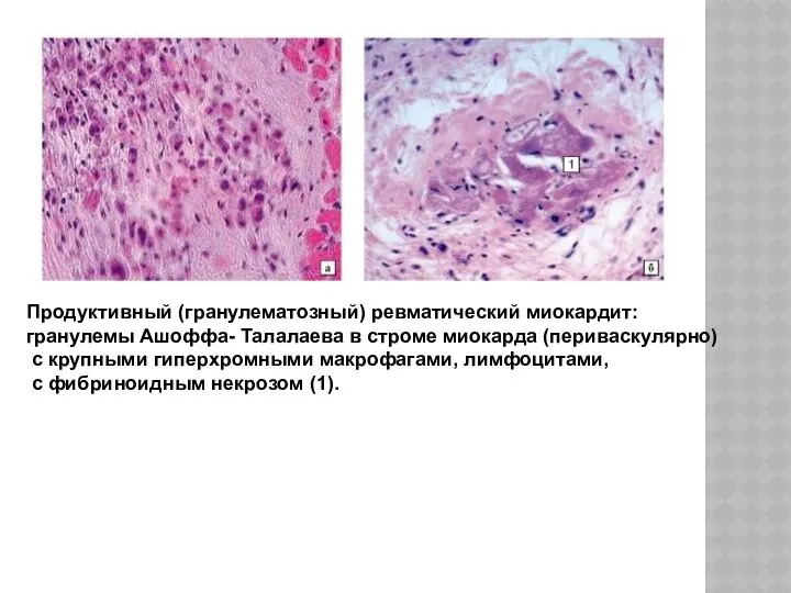 Продуктивный (гранулематозный) ревматический миокардит: гранулемы Ашоффа- Талалаева в строме миокарда (периваскулярно)