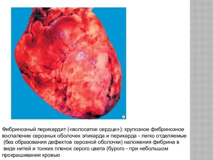 Фибринозный перикардит («волосатое сердце»): крупозное фибринозное воспаление серозных оболочек эпикарда и
