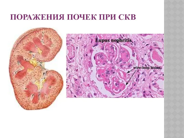 ПОРАЖЕНИЯ ПОЧЕК ПРИ СКВ