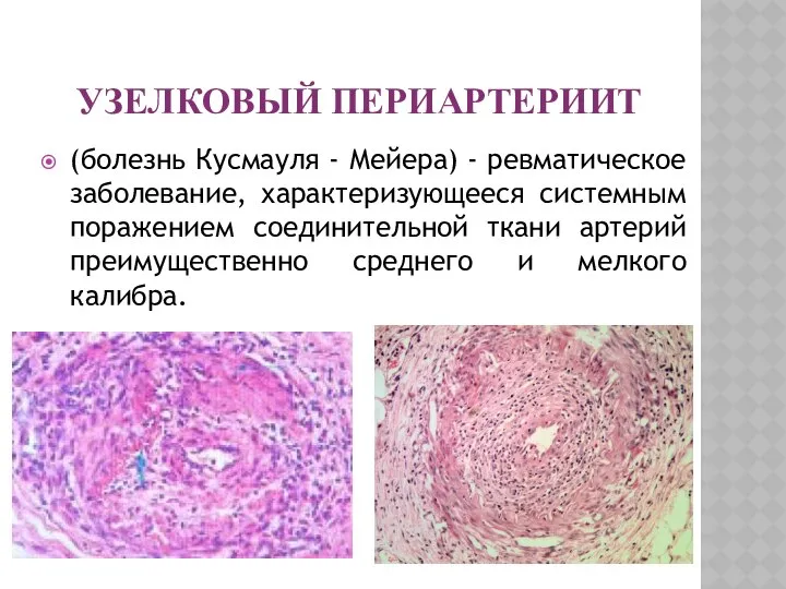 УЗЕЛКОВЫЙ ПЕРИАРТЕРИИТ (болезнь Кусмауля - Мейера) - ревматическое заболевание, характеризующееся системным