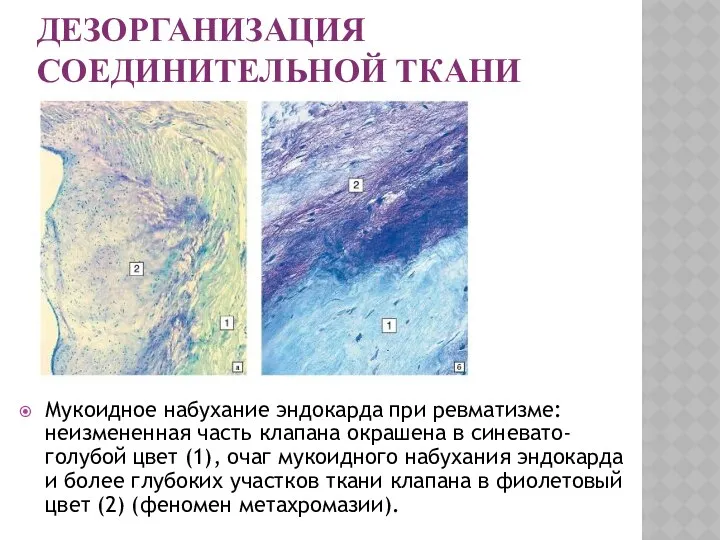 ДЕЗОРГАНИЗАЦИЯ СОЕДИНИТЕЛЬНОЙ ТКАНИ Мукоидное набухание эндокарда при ревматизме: неизмененная часть клапана