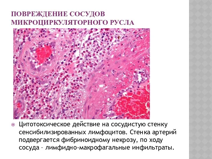 ПОВРЕЖДЕНИЕ СОСУДОВ МИКРОЦИРКУЛЯТОРНОГО РУСЛА Цитотоксическое действие на сосудистую стенку сенсибилизированных лимфоцитов.