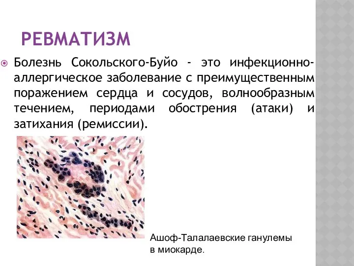 РЕВМАТИЗМ Болезнь Сокольского-Буйо - это инфекционно-аллергическое заболевание с преимущественным поражением сердца