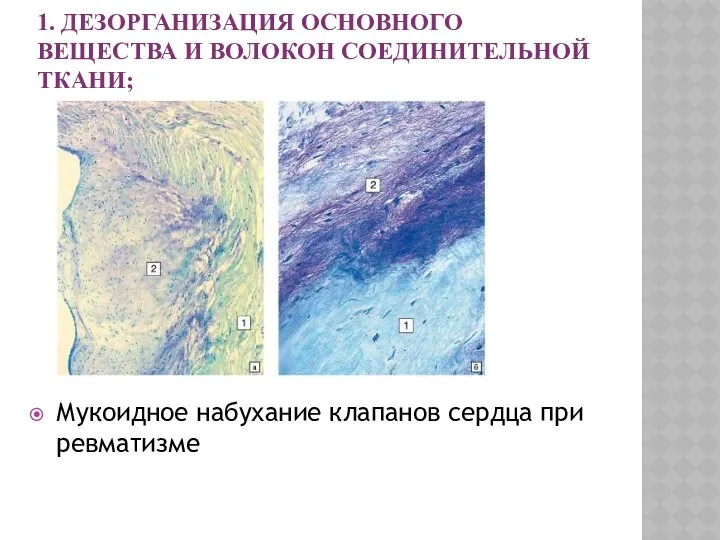 1. ДЕЗОРГАНИЗАЦИЯ ОСНОВНОГО ВЕЩЕСТВА И ВОЛОКОН СОЕДИНИТЕЛЬНОЙ ТКАНИ; Мукоидное набухание клапанов сердца при ревматизме