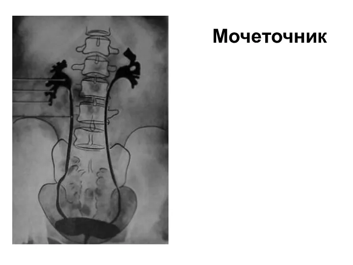 Мочеточник