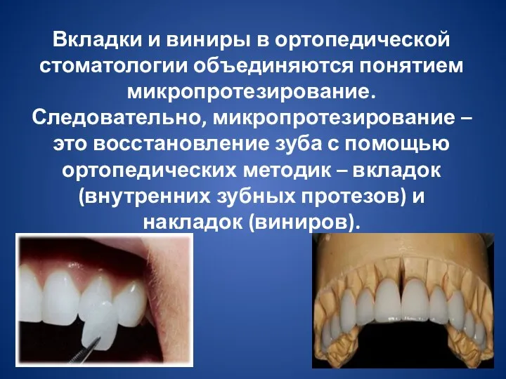 Вкладки и виниры в ортопедической стоматологии объединяются понятием микропротезирование. Следовательно, микропротезирование