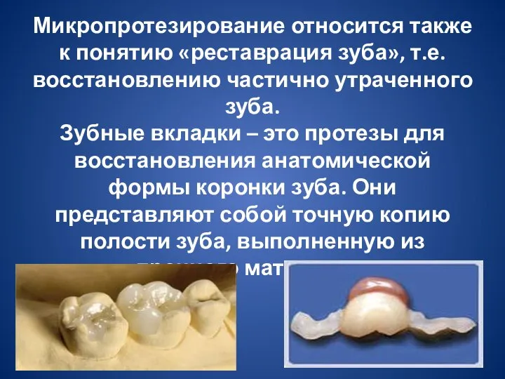 Микропротезирование относится также к понятию «реставрация зуба», т.е. восстановлению частично утраченного