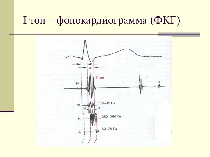 І тон – фонокардиограмма (ФКГ)