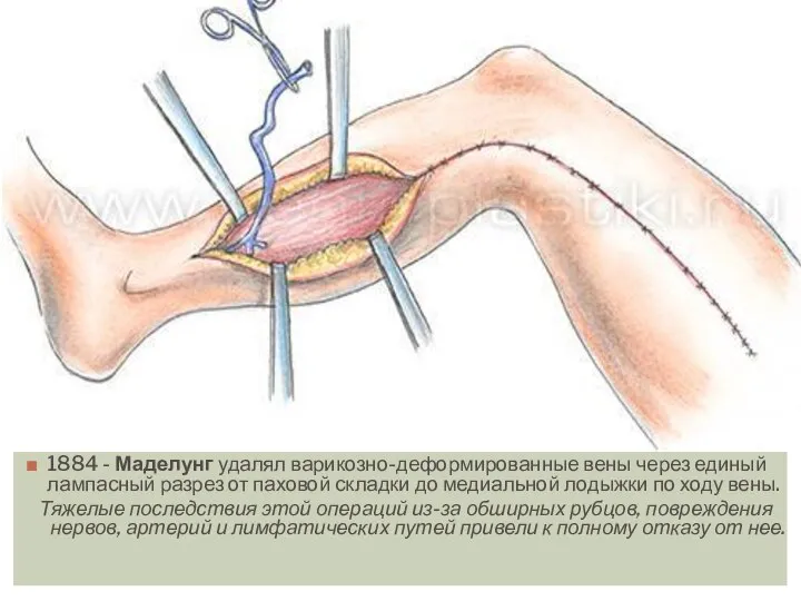 1884 - Маделунг удалял варикозно-деформированные вены через единый лампасный разрез от