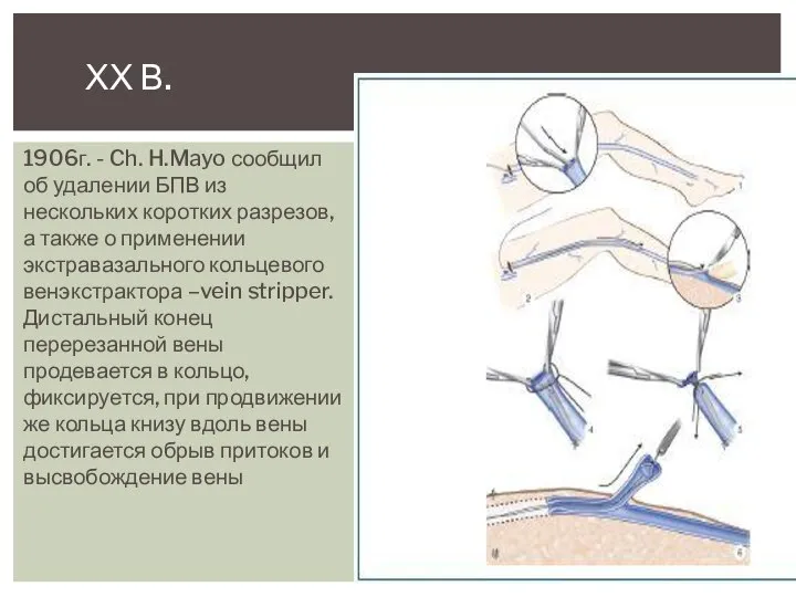 ХХ В. 1906г. - Ch. H.Mayo сообщил об удалении БПВ из