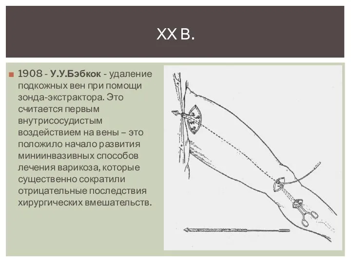 1908 - У.У.Бэбкок - удаление подкожных вен при помощи зонда-экстрактора. Это