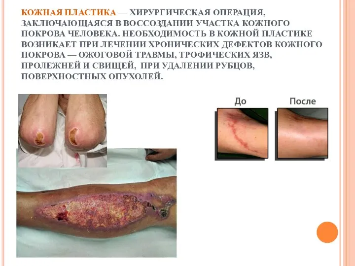 КОЖНАЯ ПЛАСТИКА — ХИРУРГИЧЕСКАЯ ОПЕРАЦИЯ, ЗАКЛЮЧАЮЩАЯСЯ В ВОССОЗДАНИИ УЧАСТКА КОЖНОГО ПОКРОВА