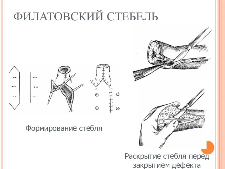 ФИЛАТОВСКИЙ СТЕБЕЛЬ Формирование стебля Раскрытие стебля перед закрытием дефекта