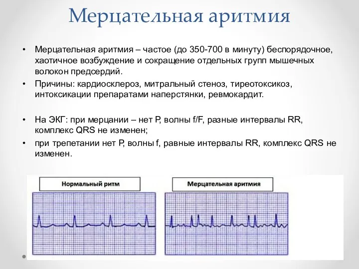 Мерцательная аритмия Мерцательная аритмия – частое (до 350-700 в минуту) беспорядочное,