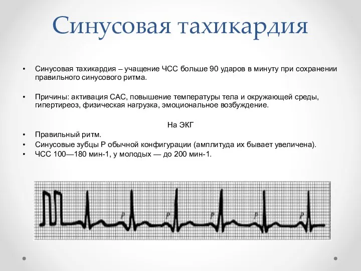 Синусовая тахикардия Синусовая тахикардия – учащение ЧСС больше 90 ударов в