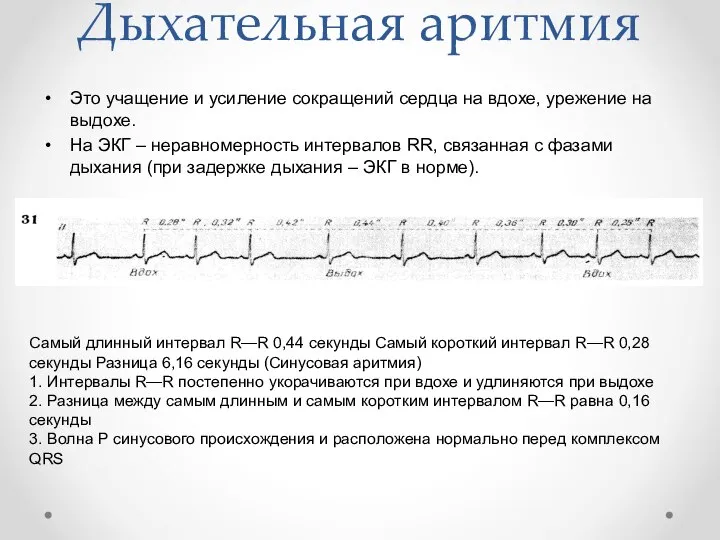 Дыхательная аритмия Это учащение и усиление сокращений сердца на вдохе, урежение