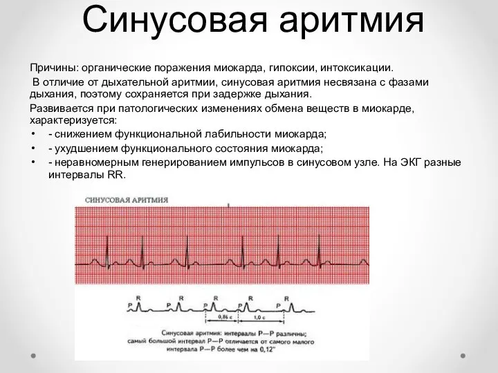 Синусовая аритмия Причины: органические поражения миокарда, гипоксии, интоксикации. В отличие от