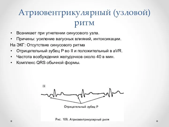 Атриовентрикулярный (узловой)ритм Возникает при угнетении синусового узла. Причины: усиление вагусных влияний,