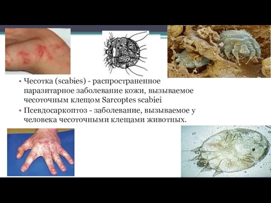 Чесотка (scabies) - распространенное паразитарное заболевание кожи, вызываемое чесоточным клещом Sarcoptes