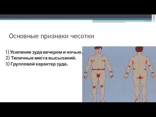 Основные признаки чесотки 1) Усиление зуда вечером и ночью. 2) Типичные