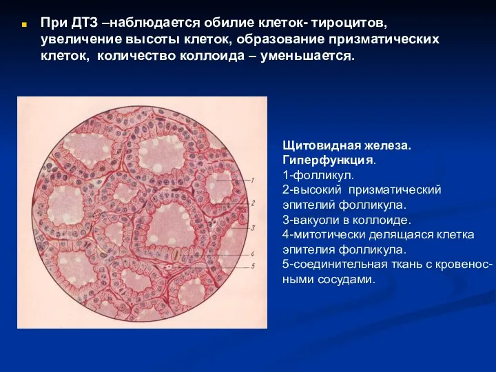 При ДТЗ –наблюдается обилие клеток- тироцитов, увеличение высоты клеток, образование призматических