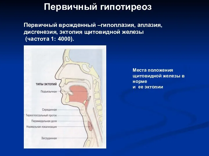 Первичный гипотиреоз Моооо Места положения щитовидной железы в норме и ее