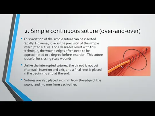 2. Simple continuous suture (over-and-over) This variation of the simple suture