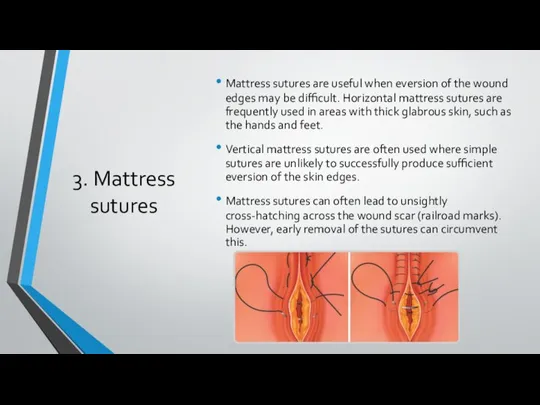 3. Mattress sutures Mattress sutures are useful when eversion of the