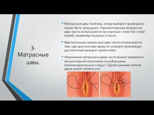 3. Матрасные швы. Матрасные швы полезны, когда выворот краев раны может