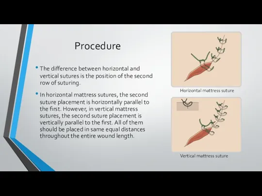 Procedure The difference between horizontal and vertical sutures is the position