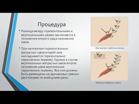 Процедура Разница между горизонтальными и вертикальными швами заключается в положении второго