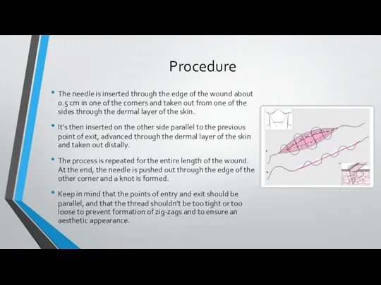 Procedure The needle is inserted through the edge of the wound