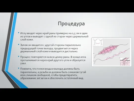 Процедура Иглу вводят через край раны примерно на 0,5 см в