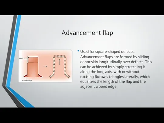 Advancement flap Used for square-shaped defects. Advancement flaps are formed by