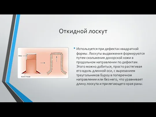 Откидной лоскут Используется при дефектах квадратной формы. Лоскуты выдвижения формируются путем