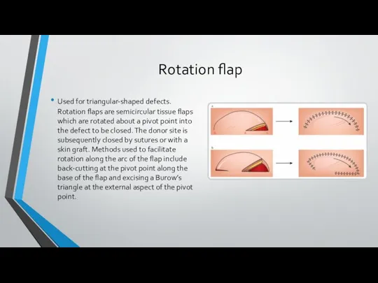 Rotation flap Used for triangular-shaped defects. Rotation flaps are semicircular tissue