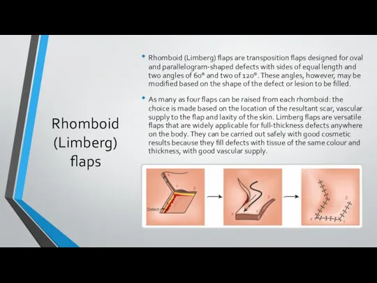 Rhomboid (Limberg) flaps Rhomboid (Limberg) flaps are transposition flaps designed for